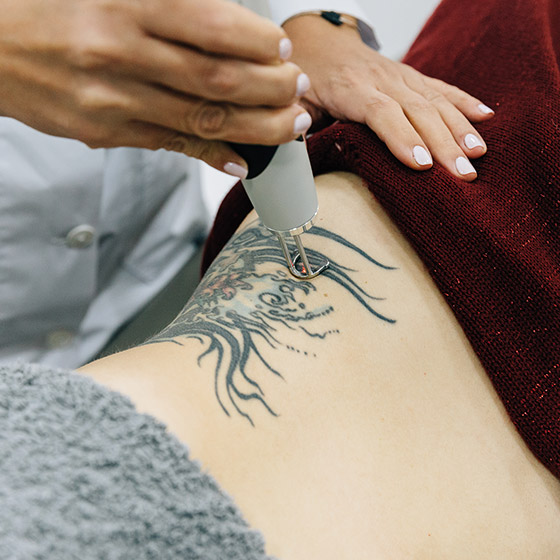 15 Top Tattoo Removal Clinics to Erase Your Ink in Singapore